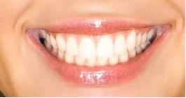 A smile after dental bonding.
