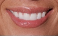A smile after dental crowns.