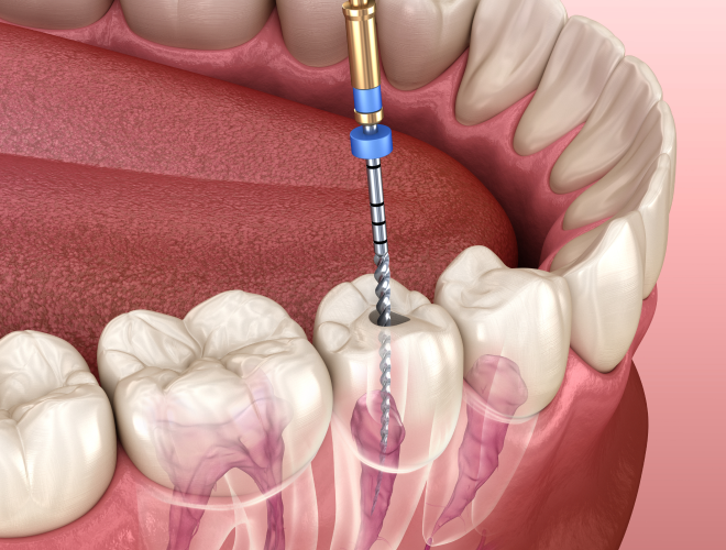 A drill going into a tooth - virtual image.