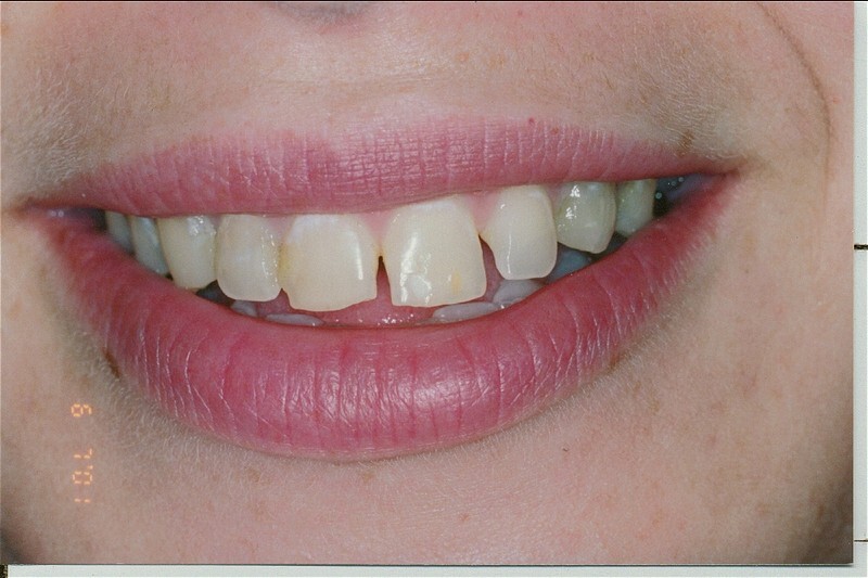 Before porcelain veneers photo.