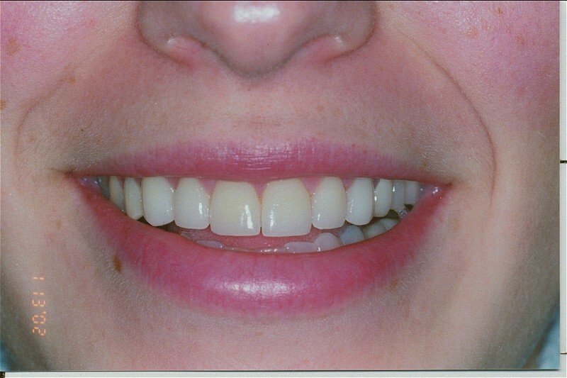 After photo of porcelain veneers.