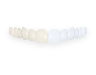 Before and after visual of teeth whitening.