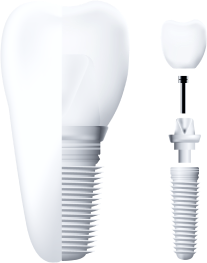 A dental implant and its three parts.